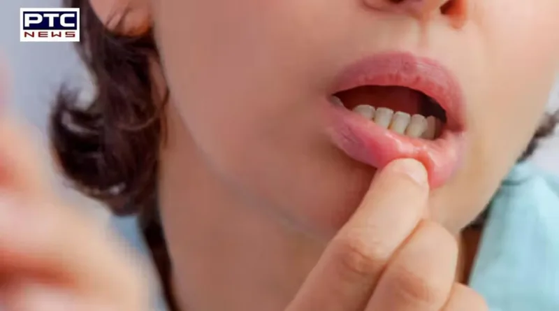 10 Effective Natural Remedies To Heal Mouth Sores